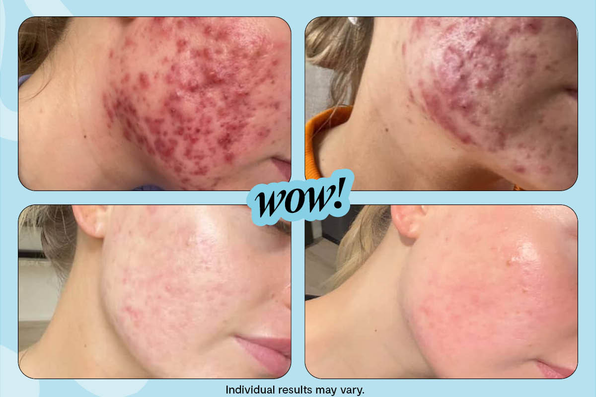 An amazing real-life acne story (with before and after photos!)
